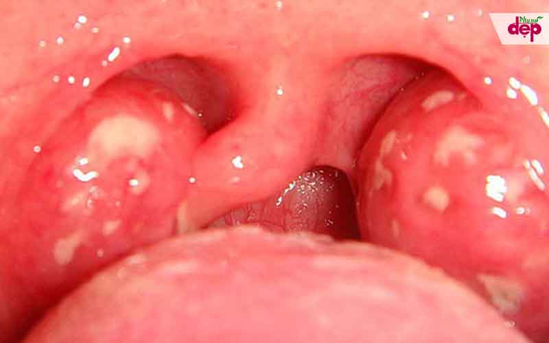 Biểu hiện lâm sàng của bệnh ung thư vòm họng